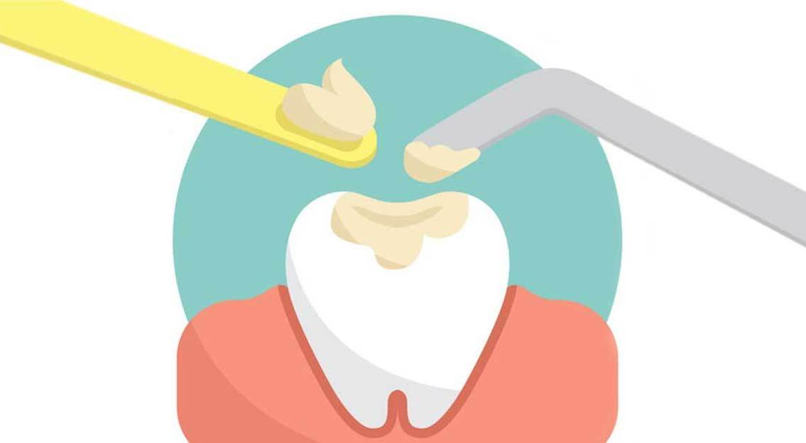 Illustration by Global Estetik Dental Care