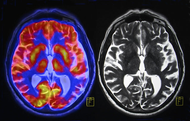 Read more about the article Brain Symmetry Index sebagai Alat Bantu Klasifikasi Stroke Iskemik Akut