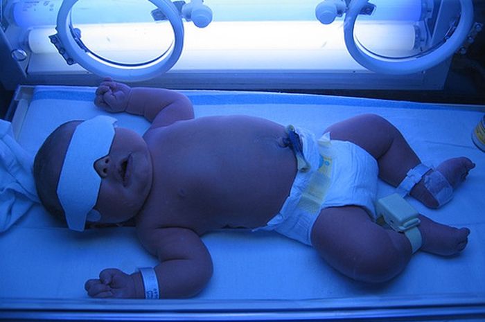 Read more about the article Treatment of Newborn Jaundice with Phototherapy Practice