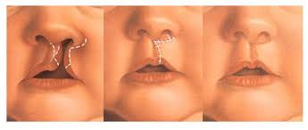 Read more about the article Analisis Gambar Permukaan Wajah pada Pasien Celah Bibir