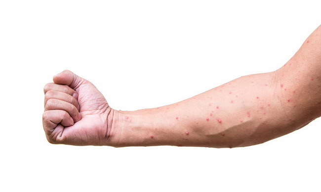 Read more about the article Hypersensitivity reactions in HIV patients