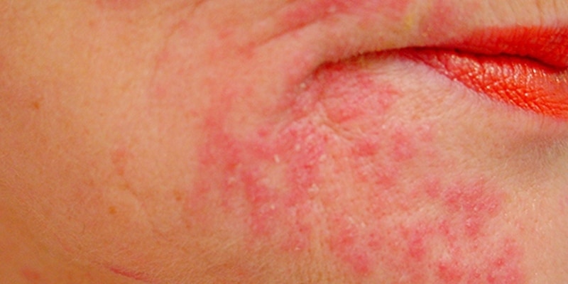 Read more about the article Dermatitis Caused by Cosmetic Use