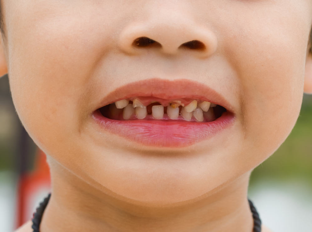 Read more about the article Caries in Children with HIV / AIDS Infection