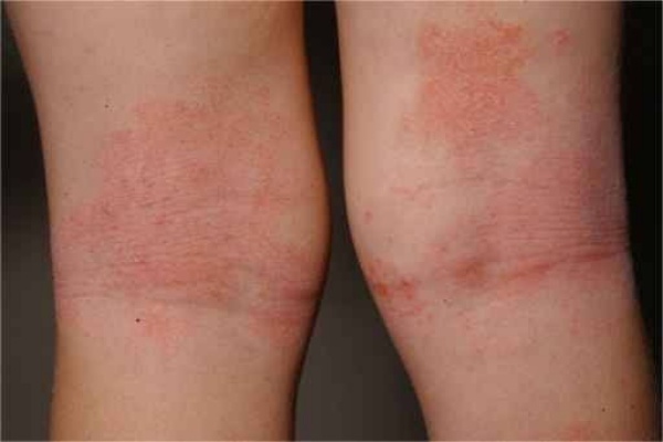 Read more about the article PH and TEWL Values from Atopic Dermatitis in Children