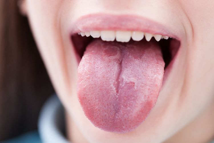 Read more about the article Coated Tongue Dan Fissured Tongue: Kelainan Lidah Terbanyak pada Pasien Lanjut Usia