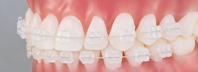 Read more about the article Peran Citosan pada Perlekatan Braket Ortodontik