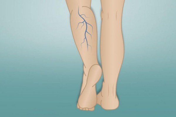 Read more about the article Mechanical Occlusion Chemically Assisted Ablation (MOCA) for saphenous vein insufficiency: A meta-analysis