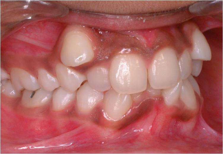 Read more about the article Korelasi antara Skeletal dan Dental Maloklusi Kelas I, II, III pada Pasien Etnis Jawa