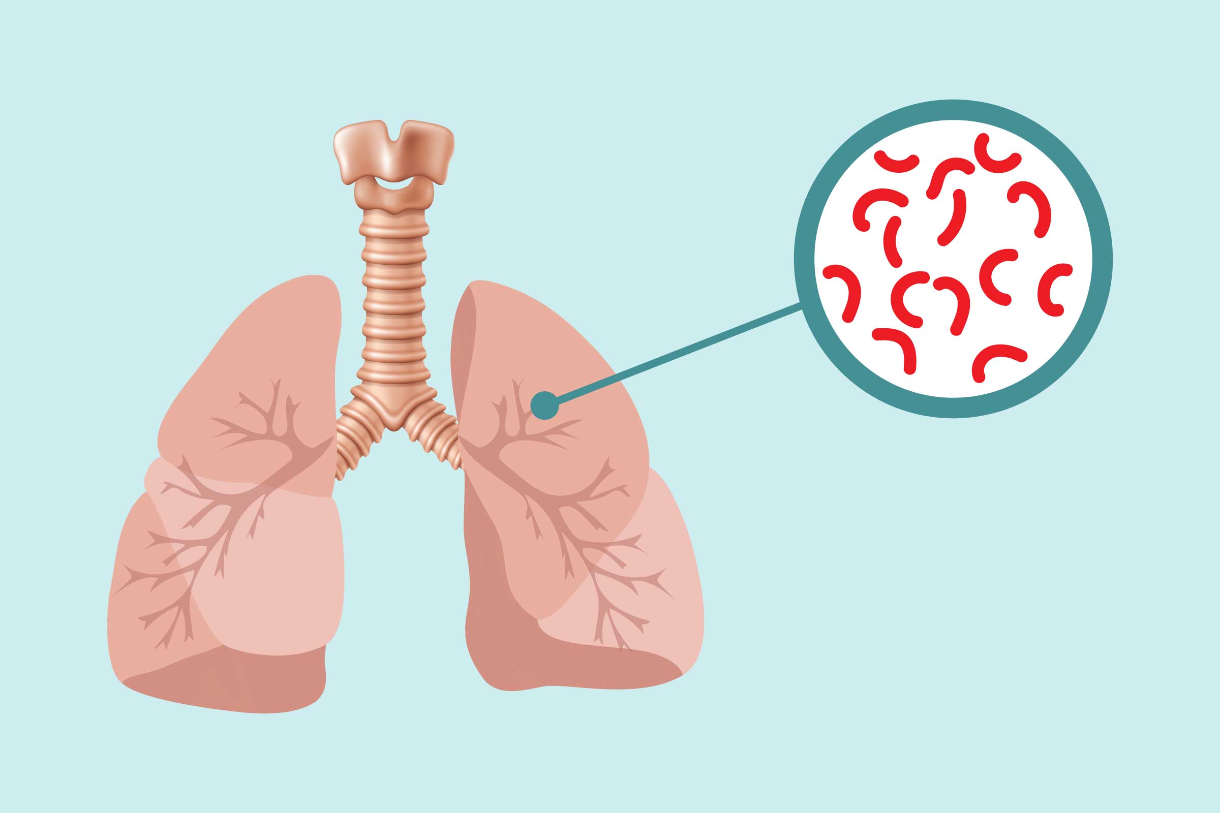 Read more about the article Faktor-Faktor Yang Berkaitan dengan Kejadian Tuberculosis di Sidoarjo