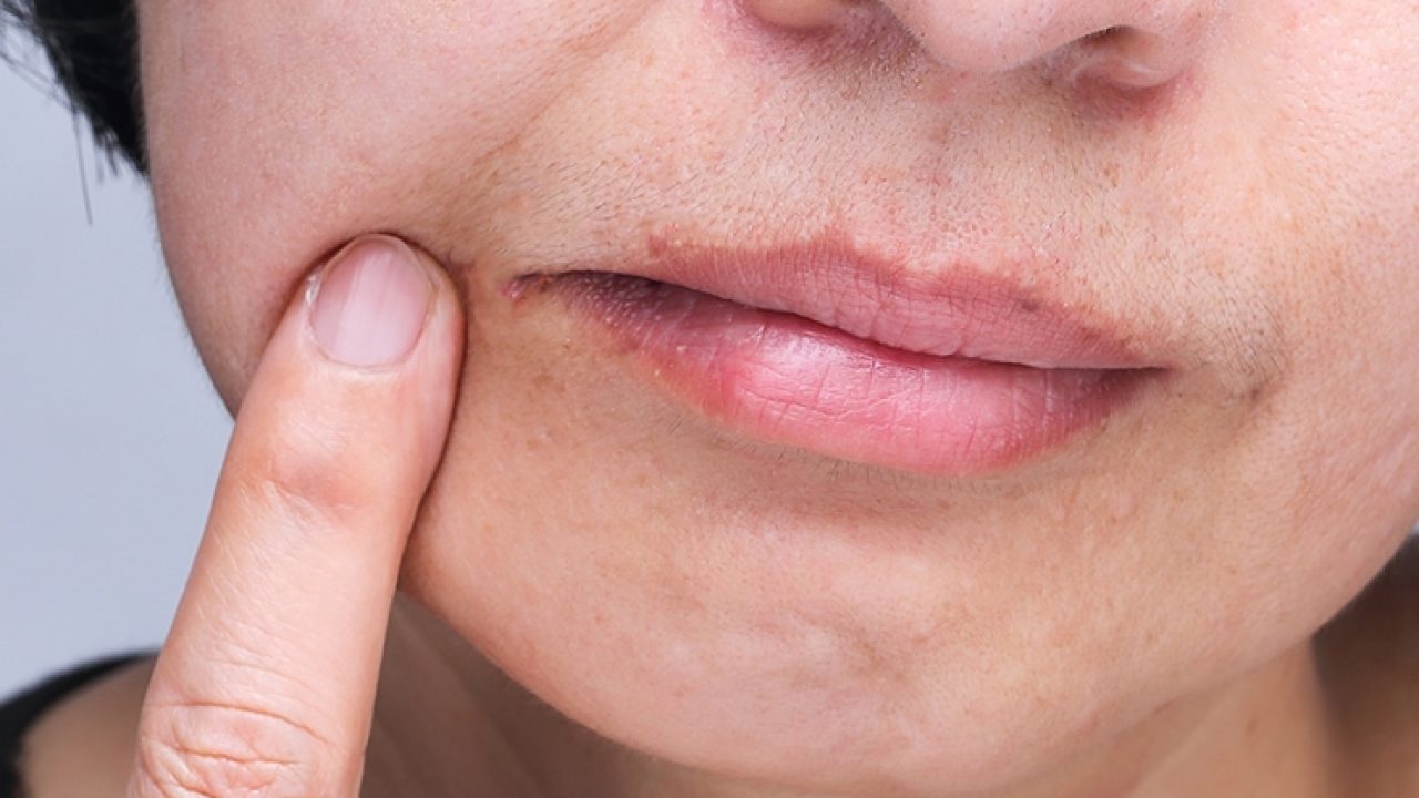 Read more about the article Apa itu Angular Cheilitis?