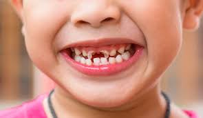 Read more about the article The influence of dental caries with general health conditions and toddlers’ daily activities