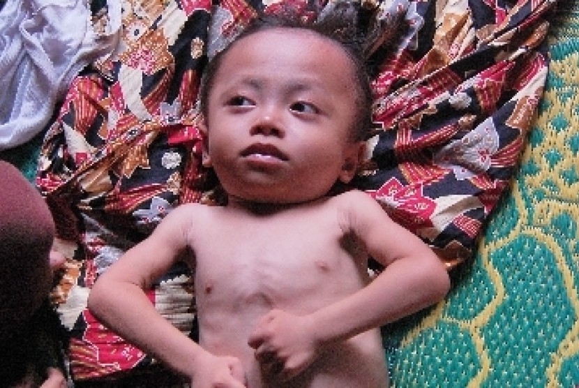 Read more about the article Penggunaan Kurva Pertumbuhan Anak WHO 2006 dan Kurva Pertumbuhan Anak Indonesia 2005 pada Malnutrisi