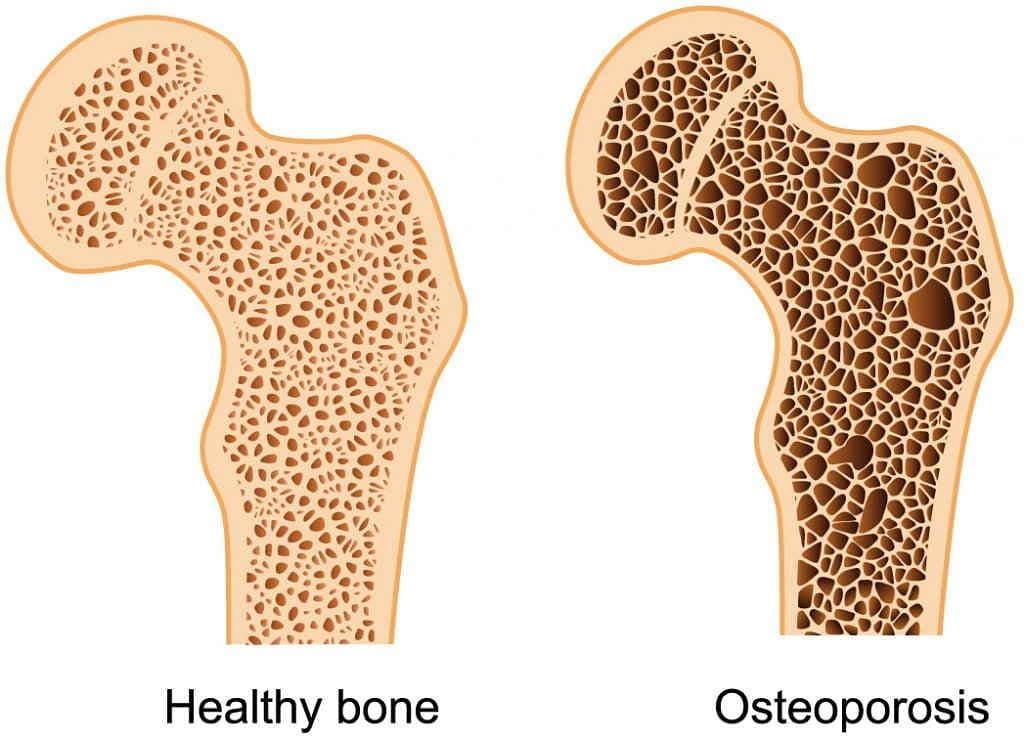 Read more about the article Ekspresi Tartrate-resistant Acid Phosphatase pada Tulang Mandibula Osteoporotik
