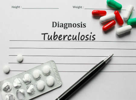 Read more about the article Understanding Oral Tuberculosis Ulcer