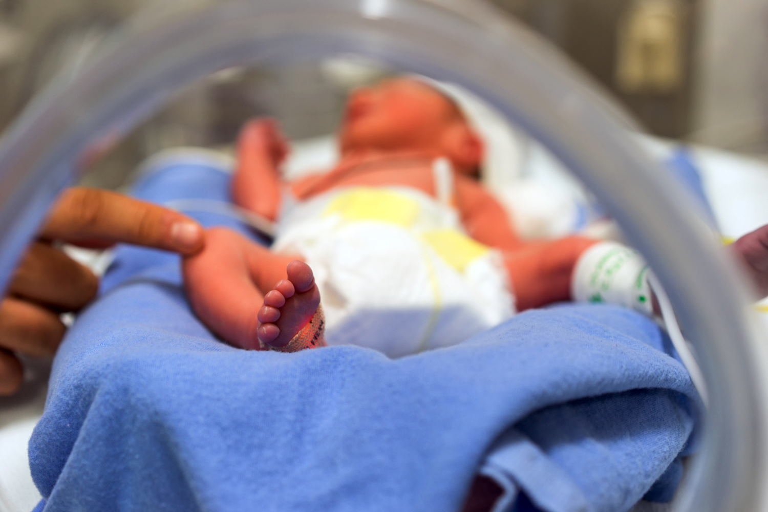 Read more about the article Penggunaan Alat Deteksi Kuning Non-Invasif untuk Prediksi Bayi Prematur