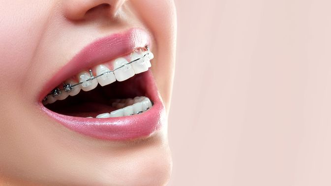 Read more about the article Sitokin dan Kemokin di Dalam Cairan Sulkus Gingiva Selama Pergerakan Gigi Ortodontik