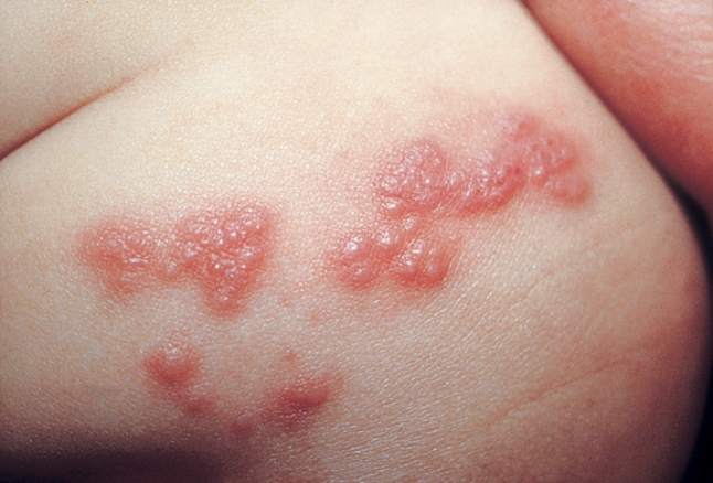 Read more about the article Herpes Zoster Pada Usia Lanjut