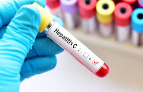 Read more about the article Identifikasi Genotip Virus Hepatitis C pada Pendonor Darah Sukarela