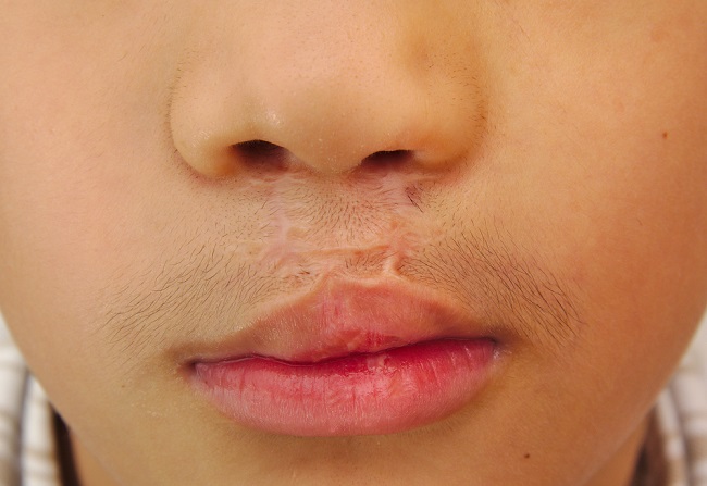 Read more about the article Pentingnya Perawatan Luka Pasca Operasi Celah Bibir dan Lelangit yang Tepat