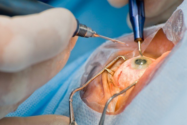 Read more about the article Potensi Metformin untuk Mencegah Kekeruhan Kapsul Lensa Pasca Operasi Katarak