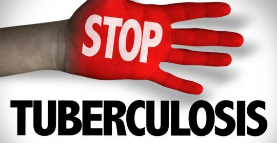 Read more about the article Tantangan Diagnostik Infeksi Laten Tuberkulosis untuk Indonesia Bebas Tuberkulosis Tahun 2050