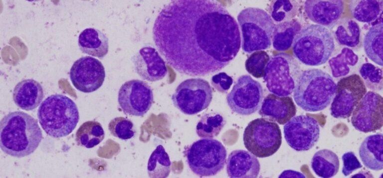 Read more about the article Deteksi Mutasi Gen FLT3 pada Leukemia Mieloid Akut