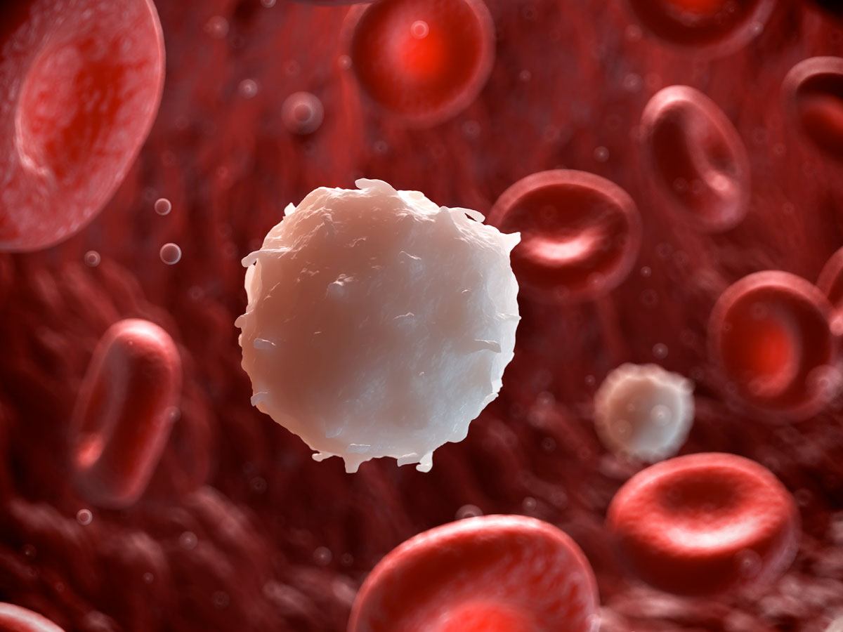 Read more about the article Mutasi Gen BCR ABL Tyrosine Kinase Mempengaruhi Resistensi Pengobatan Leukemia Granulositik Kronik