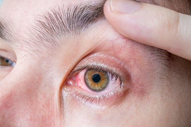 Read more about the article Peningkatan Kadar Interleukin 10 dalam Air Mata sebagai Potensi Biomarker Penyakit Mata Kering pada Pengguna Komputer