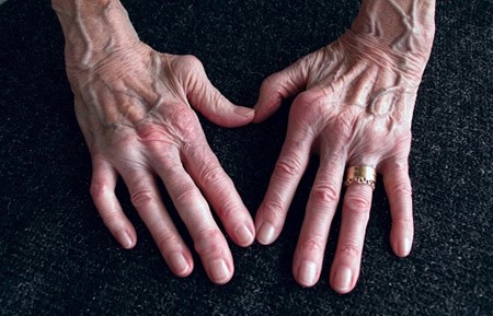 Read more about the article Terapi Oksigen Hiperbarik Dapat Menurunkan Stres Oksidatif pada Arthritis Rematik