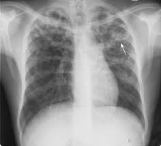 Read more about the article Selulitis Orbita pada Tuberkulosis Paru: Laporan Kasus