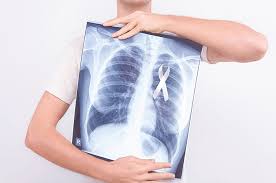Read more about the article Kadar Interleukin-4 pada Pasien Tuberkulosis yang Sensitif dan yang Kebal terhadap Rifampycin