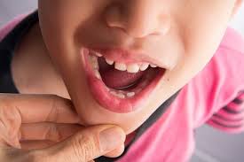 Read more about the article Peningkatan Kenyamanan Pasien Anak dengan Menggunakan Alat Preparasi Saluran  Akar Gigi berbasis Modern