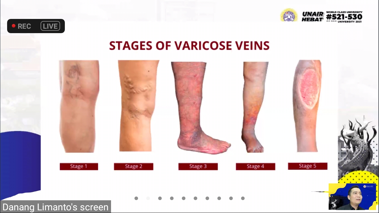 Read more about the article Severity of varicose veins and their treatment