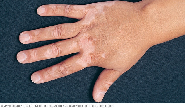 Read more about the article Benarkah Leukotrikia pada Vitiligo dapat Menurunkan Respon Terapi NB-UVB?