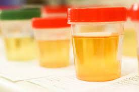 Read more about the article Penundaan Pemeriksaan Sampel Urin pH Alkali Melalui Metode Konvensional