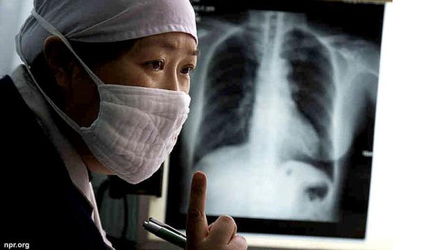 Read more about the article Kualitas Hidup dan Kesejahteraan Subjektif Pasien Tuberkulosis Paru