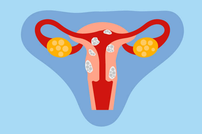 Read more about the article Manajemen Miom Uterus