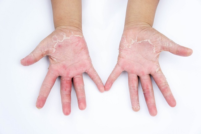 Read more about the article Mengenal Dermatitis Kontak
