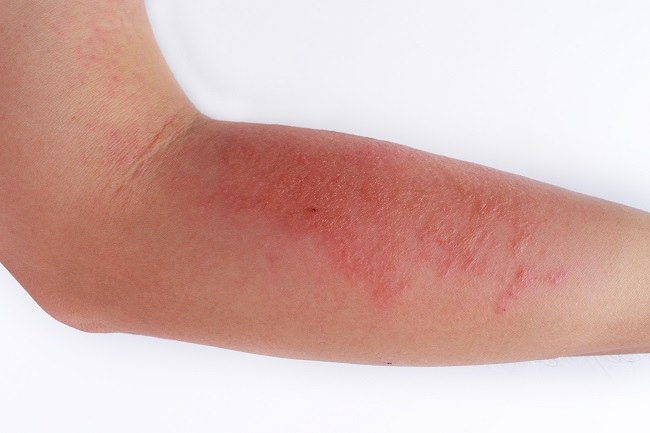 Read more about the article Skin Prick Test sebagai Alat Diagnostik Dermatitis Atopik