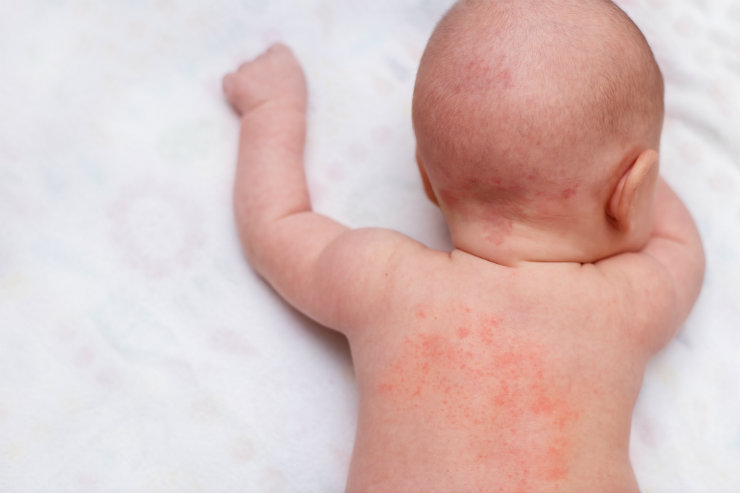 Read more about the article Faktor-Faktor Determinan Kekambuhan Gejala Dermatitis Atopi pada Anak