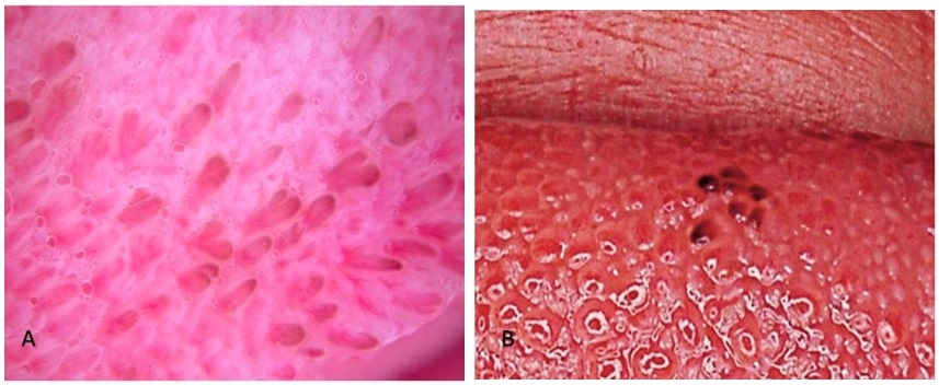 Read more about the article Pemeriksaan Dermoskopi untuk Menegakkan Kasus Pigmented Fungiform Papillae