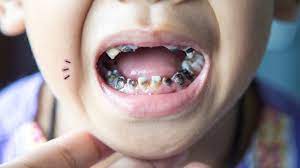 sakit gigi pada anak kecil 16