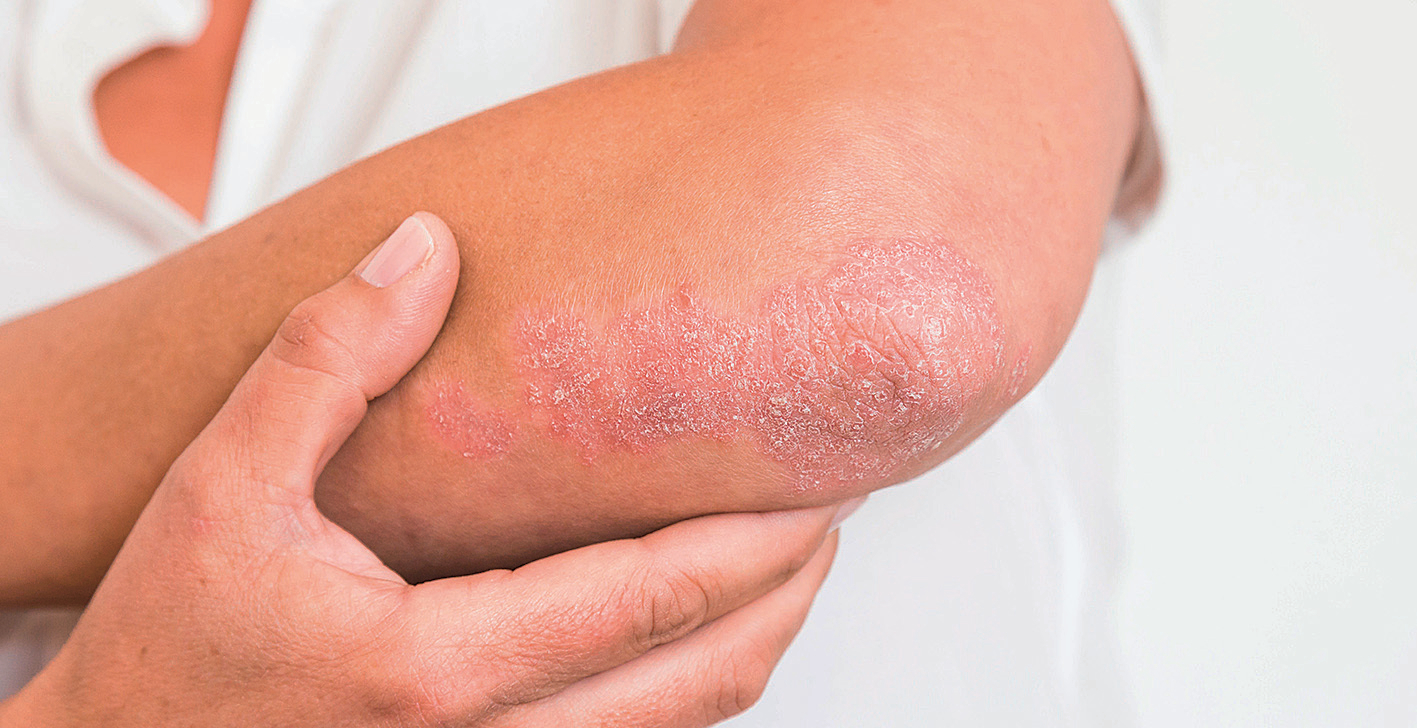Read more about the article Profil Pasien Psoriasis Vulgaris