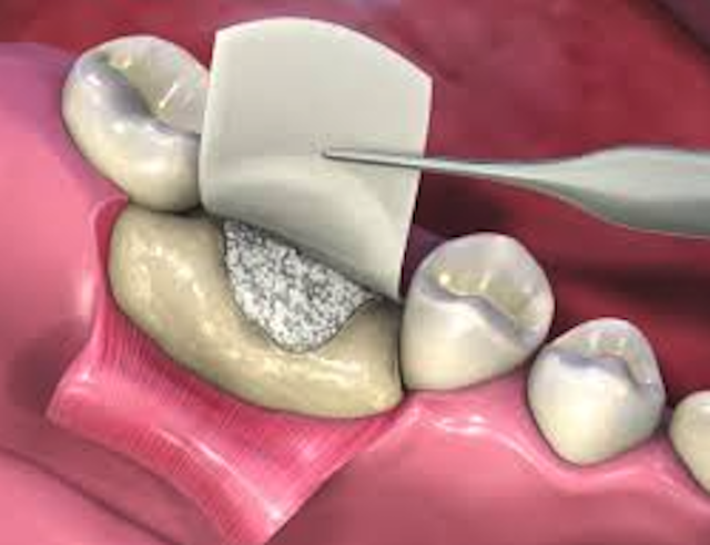 Read more about the article Peran  Demineralized Dentin Material Membran sebagai Guided Bone Regeneration