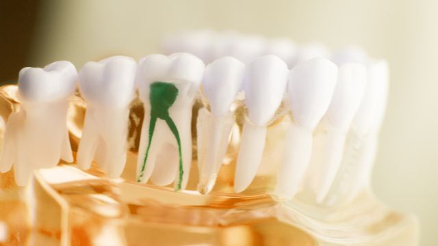 Read more about the article Perawatan Ulang Saluran Akar pada Gigi dengan Pengisian Saluran Akar Yang Tidak Sempurna Disertai Abses Periapikal Kronis