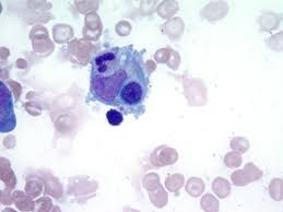 Read more about the article Mengenal Hemophagocytic Lymphohistiocytosis