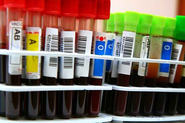 Read more about the article Pengaruh Membran Perikardium Terhadap Laju Adsorpsi Darah Tipe O