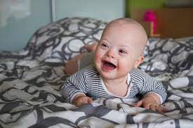 Read more about the article Peranan Saliva Nitric Oxide Terhadap Status Karies Anak Down Syndrome