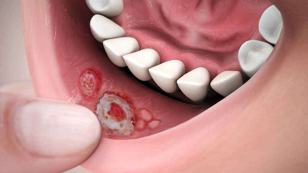 Read more about the article Tata Laksana Pasien Aphthous-Like Ulcer terkait Anemia Aplastik melalui Teledentistry